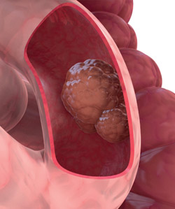 Vastagbélrák (colon carcinoma, colorectalis carcinoma)